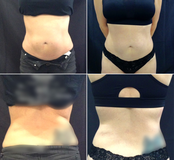 Before and after image Sculpture after 2 treatments of love handles abdomen and bra roles