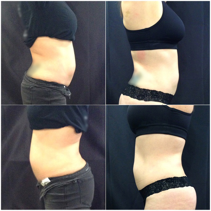 Before and after image Sculpture after 2 treatments of love handles abdomen and bra roles