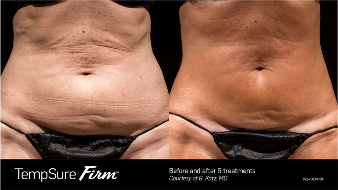 Tempsure firm before and after 5 treatments image