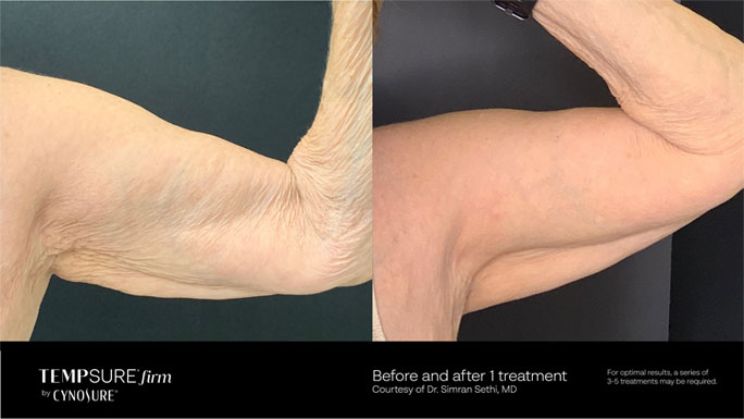 Tempsure firm before and after 1 treatment image